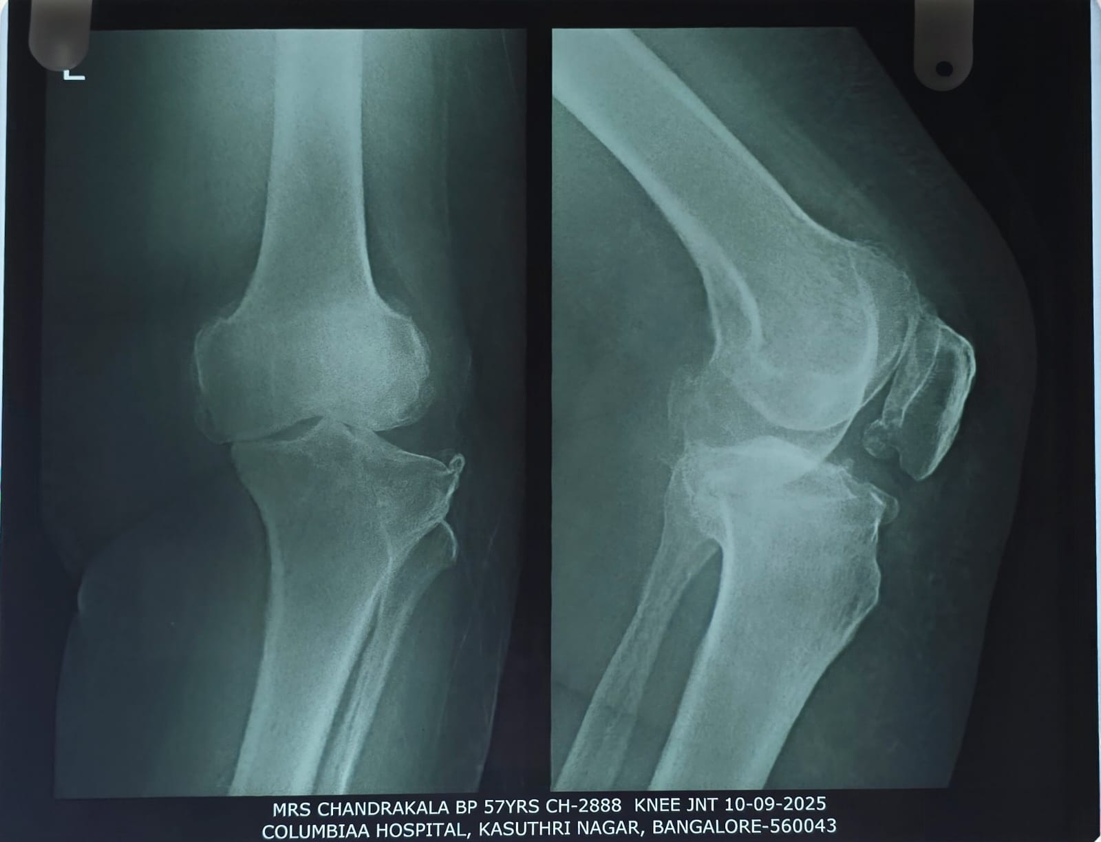 Before bilateral knee replacement X-ray showing arthritic joint